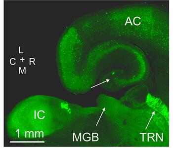 thalamic reticular nucleus